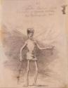 Francisco de Goya, Claudio Ambrosio Surat, bekannt als lebendes Skelett